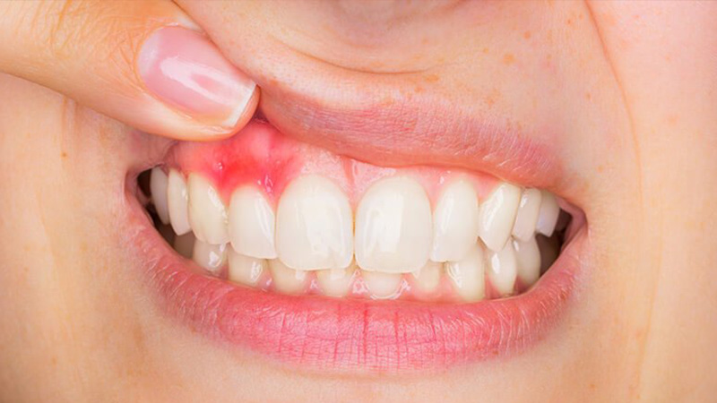 Inflamed gums
